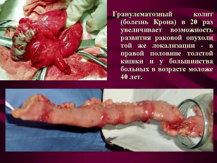 Гранулематозный колит (болезнь Крона) в 20 раз увеличивает возможность развития раковой опухоли той же