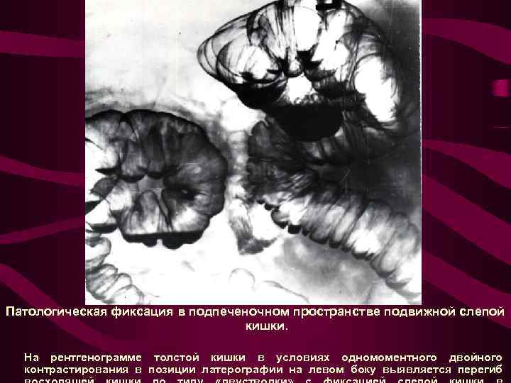 Патологическая фиксация в подпеченочном пространстве подвижной слепой кишки. На рентгенограмме толстой кишки в условиях