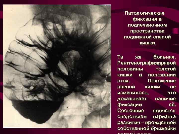 Патологическая фиксация в подпеченочном пространстве подвижной слепой кишки. Та же больная. Рентгенографияправой половины толстой