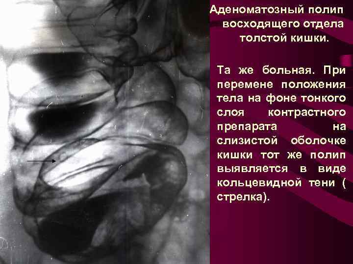 Аденоматозный полип восходящего отдела толстой кишки. Та же больная. При перемене положения тела на