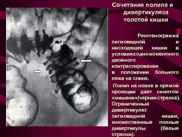 Сочетание полипа и дивертикулеза толстой кишки Рентгенограмма сигмовидной и нисходящей кишки в условиях одномоментного