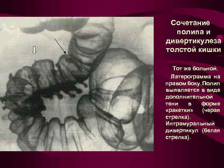 Сочетание полипа и дивертикулеза толстой кишки Тот же больной. Латерограмма на правом боку. Полип