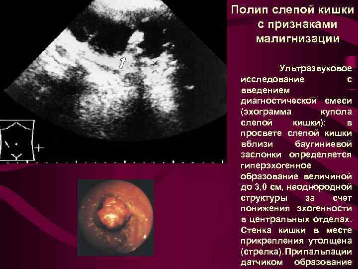 Полип слепой кишки с признаками малигнизации Ультразвуковое исследование с введением диагностической смеси (эхограмма купола