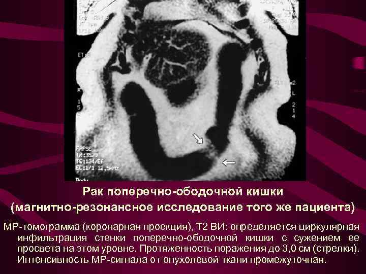 Рак поперечно-ободочной кишки (магнитно-резонансное исследование того же пациента) МР-томограмма (коронарная проекция), Т 2 ВИ: