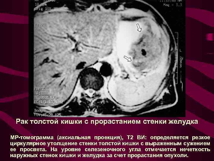 Рак толстой кишки с прорастанием стенки желудка МР-томограмма (аксиальная проекция), Т 2 ВИ: определяется