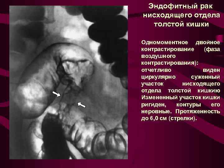 Эндофитный рак нисходящего отдела толстой кишки Одномоментное двойное контрастирование (фаза воздушного контрастирования): отчетливо виден