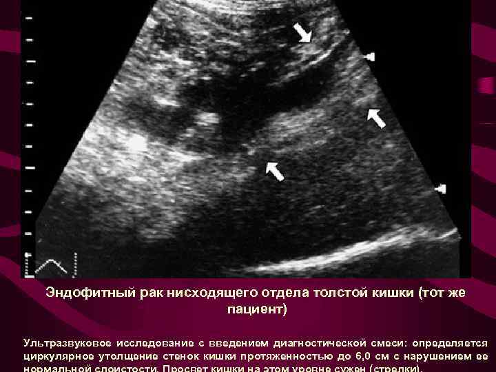Эндофитный рак нисходящего отдела толстой кишки (тот же пациент) Ультразвуковое исследование с введением диагностической