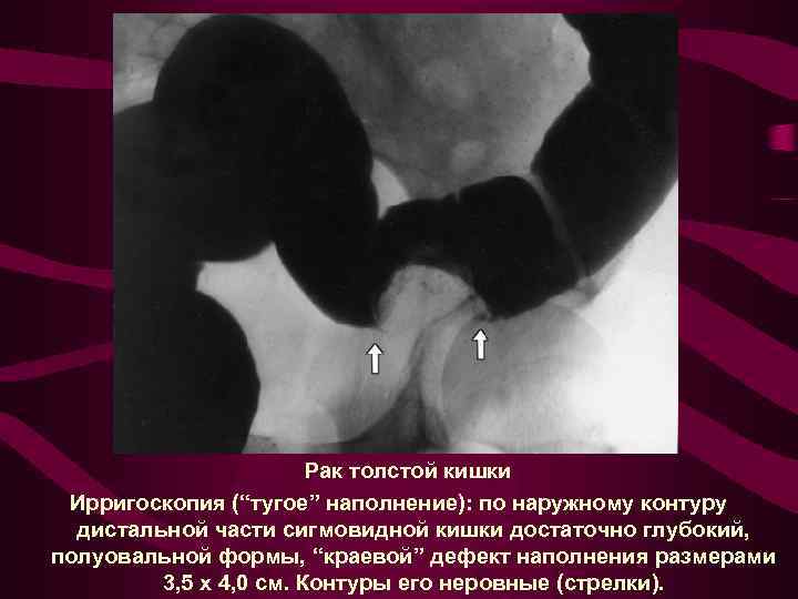 Рак толстой кишки Ирригоскопия (“тугое” наполнение): по наружному контуру дистальной части сигмовидной кишки достаточно