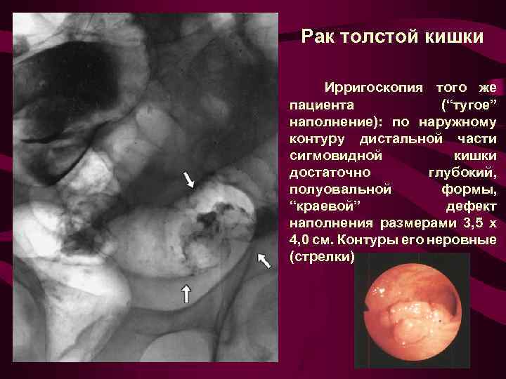 Рак толстой кишки Ирригоскопия того же пациента (“тугое” наполнение): по наружному контуру дистальной части
