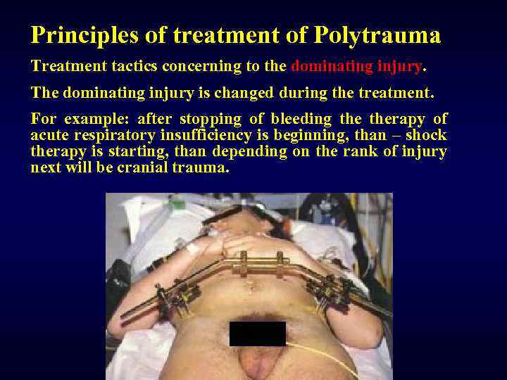 Principles of treatment of Polytrauma Treatment tactics concerning to the dominating injury. The dominating
