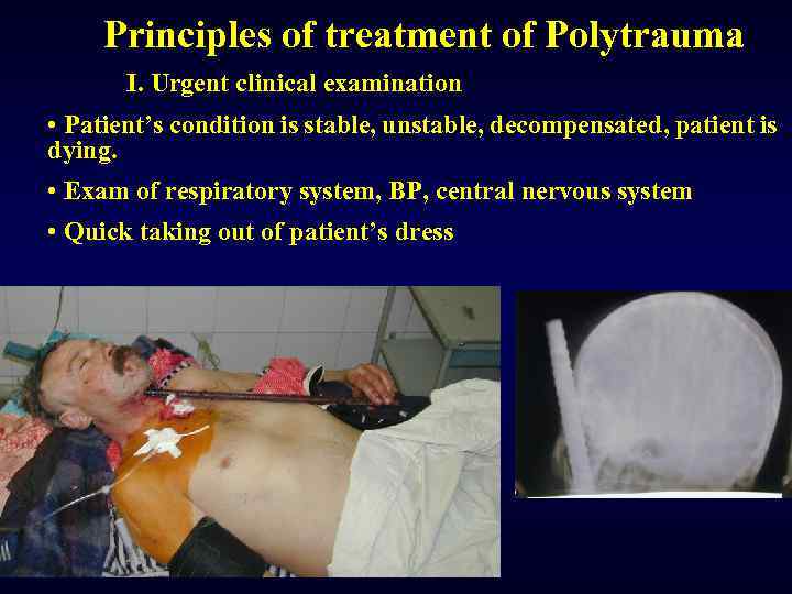Principles of treatment of Polytrauma I. Urgent clinical examination • Patient’s condition is stable,