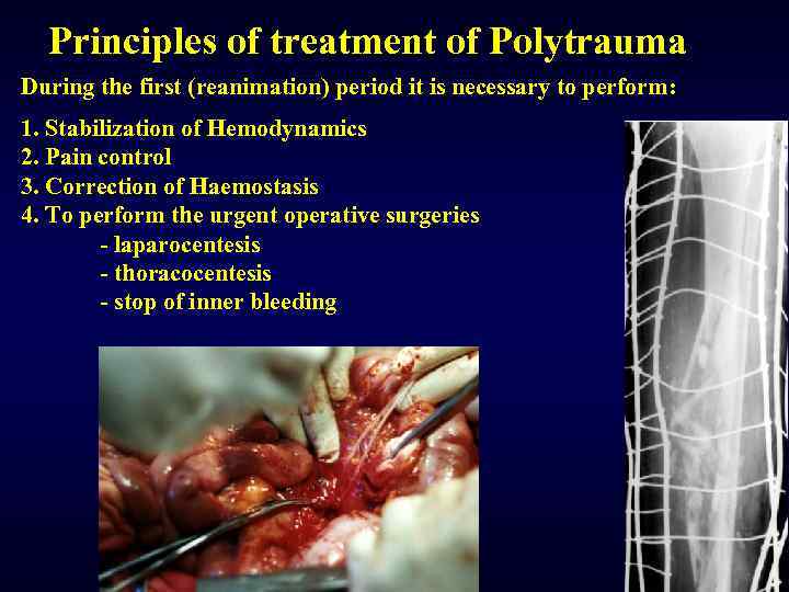 Principles of treatment of Polytrauma During the first (reanimation) period it is necessary to