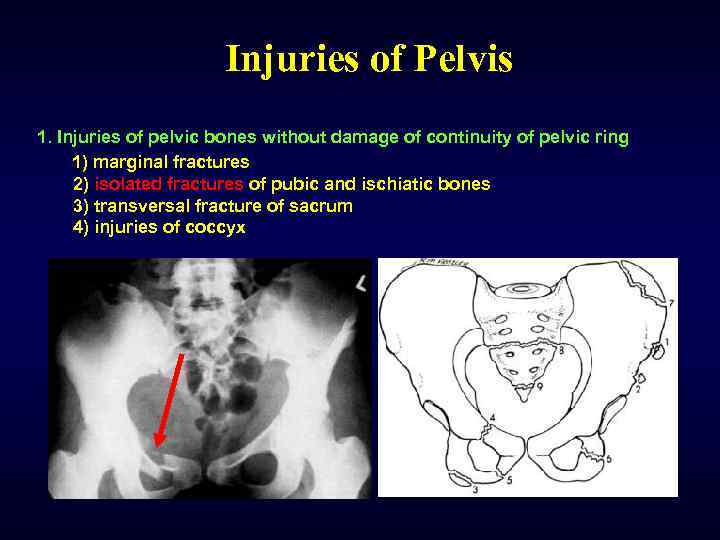 Injuries of Pelvis 1. Injuries of pelvic bones without damage of continuity of pelvic