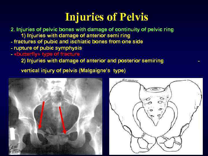 Injuries of Pelvis 2. Injuries of pelvic bones with damage of continuity of pelvic