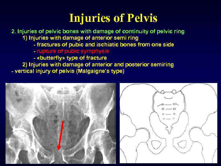 Injuries of Pelvis 2. Injuries of pelvic bones with damage of continuity of pelvic