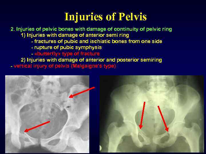 Injuries of Pelvis 2. Injuries of pelvic bones with damage of continuity of pelvic