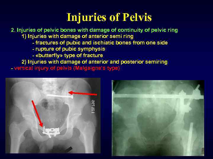 Injuries of Pelvis 2. Injuries of pelvic bones with damage of continuity of pelvic