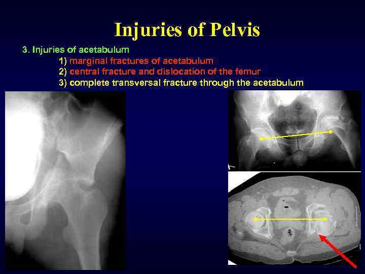 Injuries of Pelvis 3. Injuries of acetabulum 1) marginal fractures of acetabulum 2) central