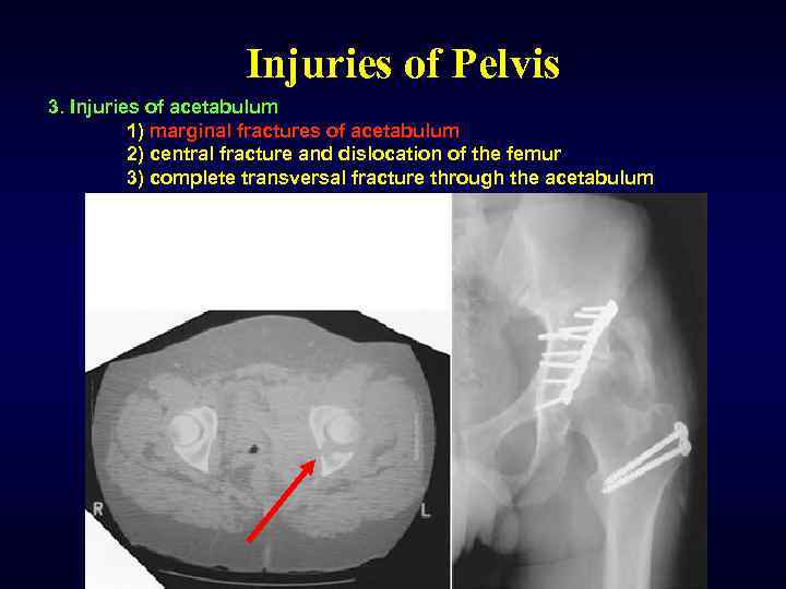 Injuries of Pelvis 3. Injuries of acetabulum 1) marginal fractures of acetabulum 2) central