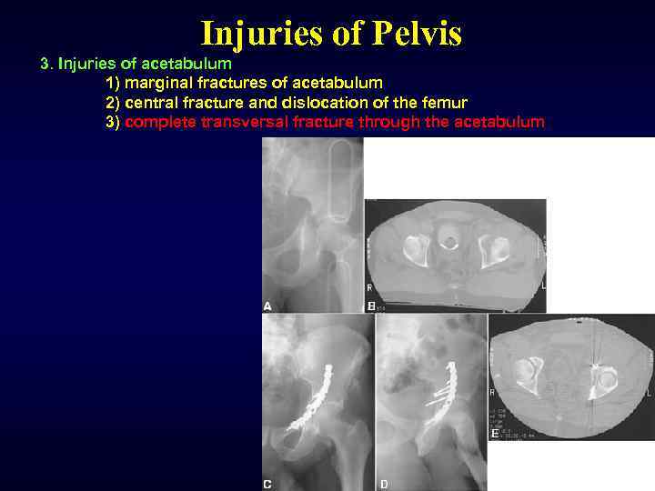Injuries of Pelvis 3. Injuries of acetabulum 1) marginal fractures of acetabulum 2) central