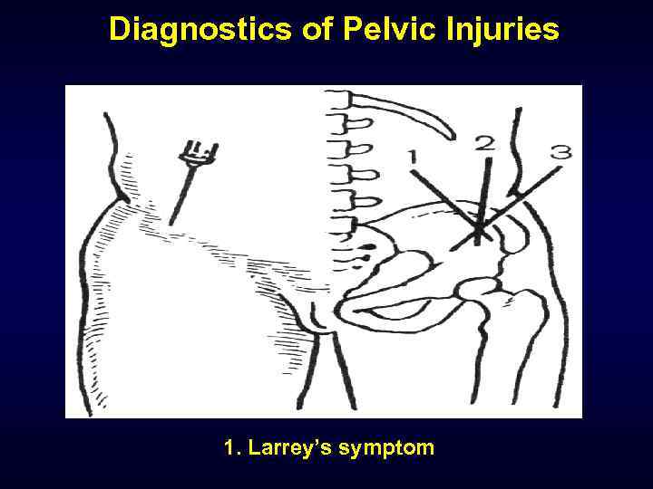 Diagnostics of Pelvic Injuries 1. Larrey’s symptom 