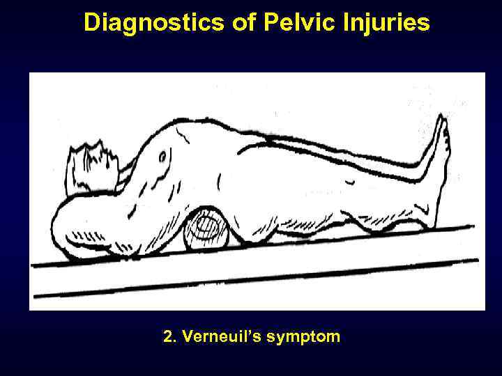 Diagnostics of Pelvic Injuries 2. Verneuil’s symptom 