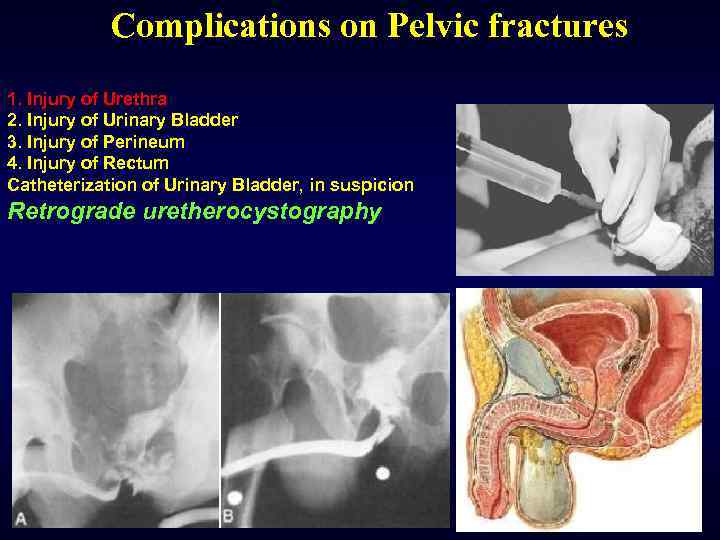 Complications on Pelvic fractures 1. Injury of Urethra 2. Injury of Urinary Bladder 3.