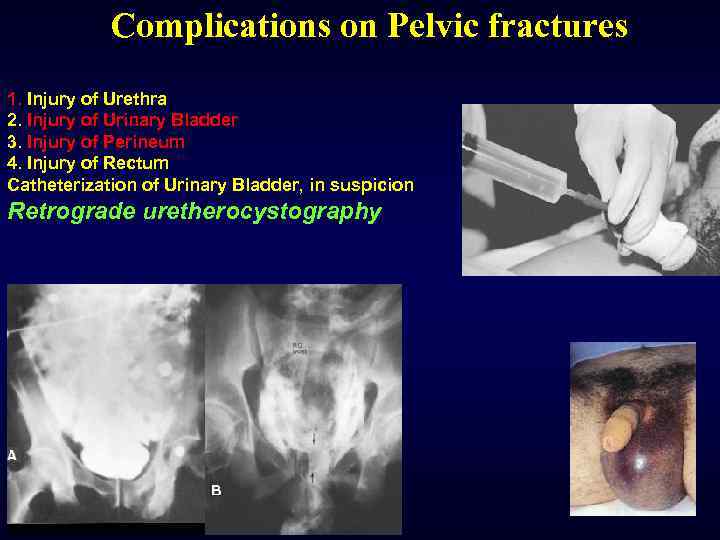 Complications on Pelvic fractures 1. Injury of Urethra 2. Injury of Urinary Bladder 3.