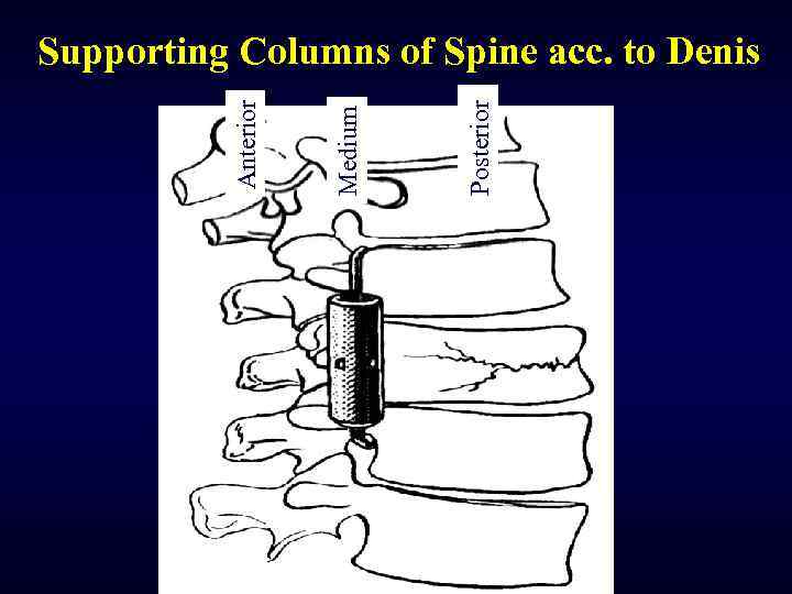Posterior Medium Anterior Supporting Columns of Spine acc. to Denis 