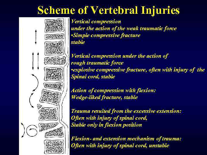 Scheme of Vertebral Injuries Vertical compression under the action of the weak traumatic force