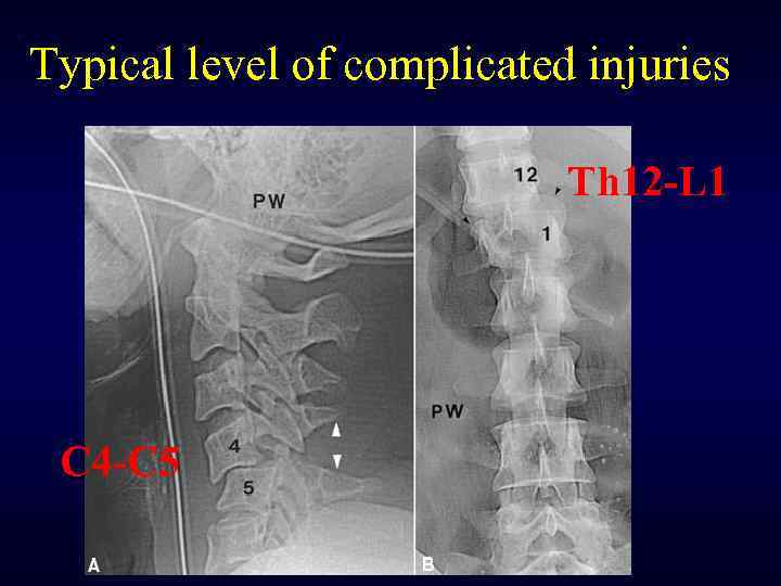 Typical level of complicated injuries Th 12 -L 1 С 4 -С 5 