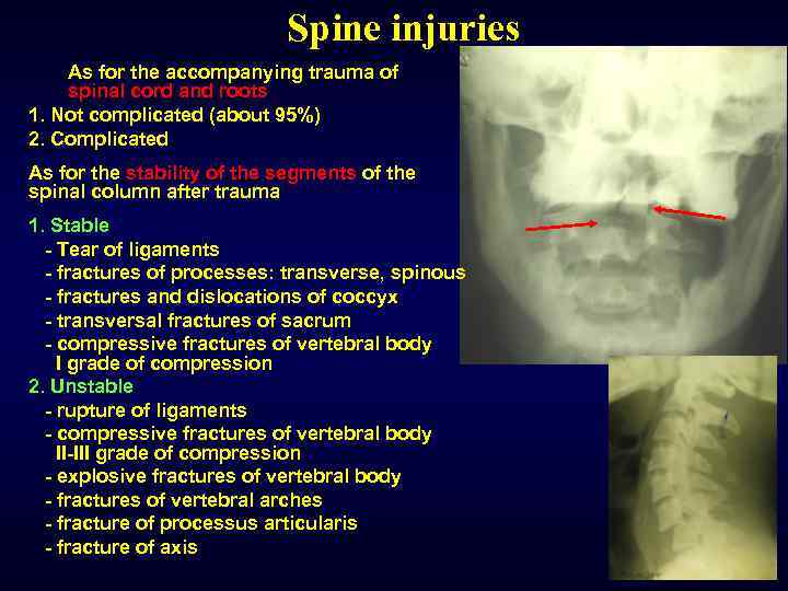 Spine injuries As for the accompanying trauma of spinal cord and roots 1. Not