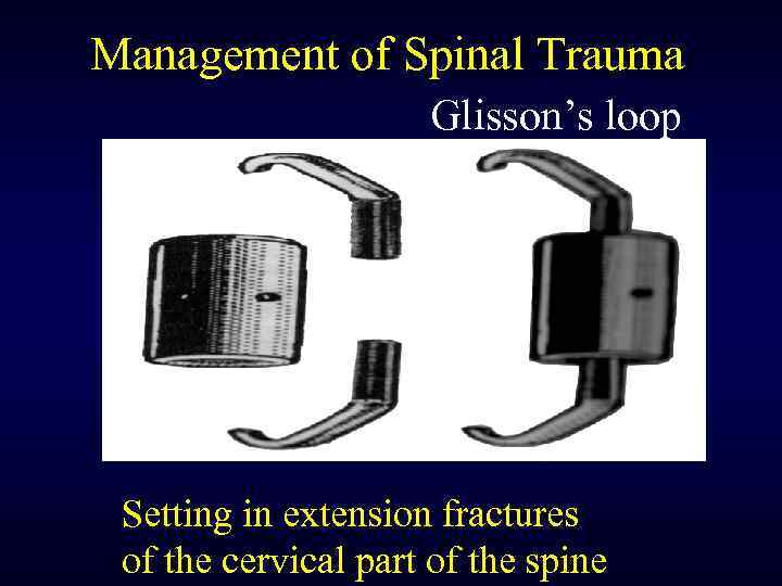 Management of Spinal Trauma Glisson’s loop Setting in extension fractures of the cervical part