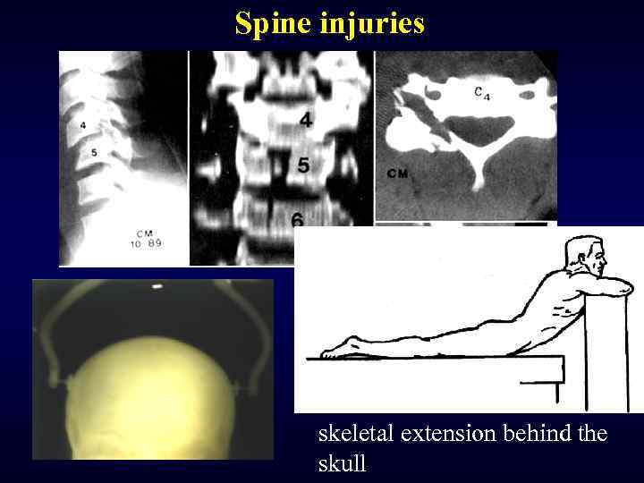Spine injuries skeletal extension behind the skull 
