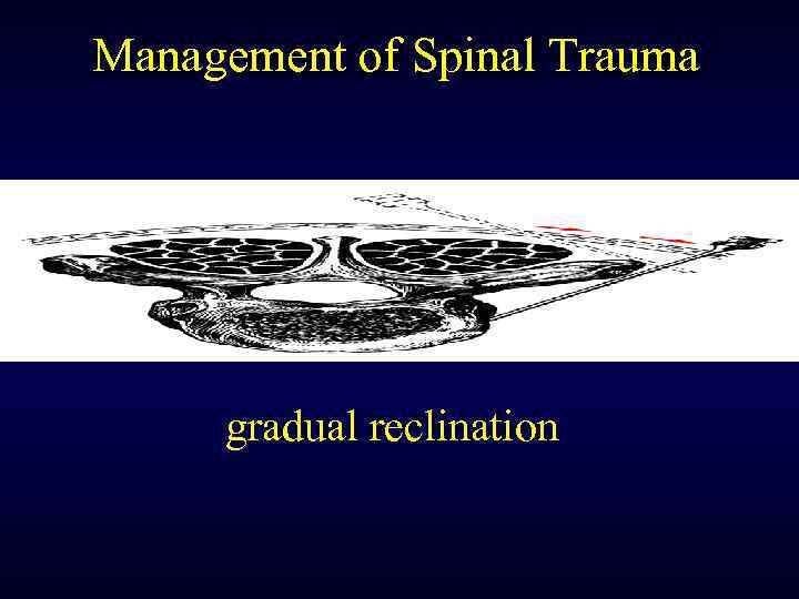 Management of Spinal Trauma gradual reclination 