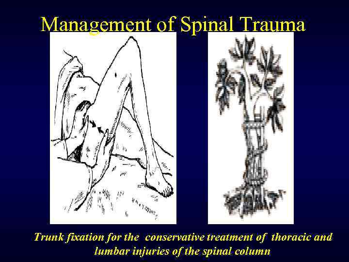 Management of Spinal Trauma Trunk fixation for the conservative treatment of thoracic and lumbar