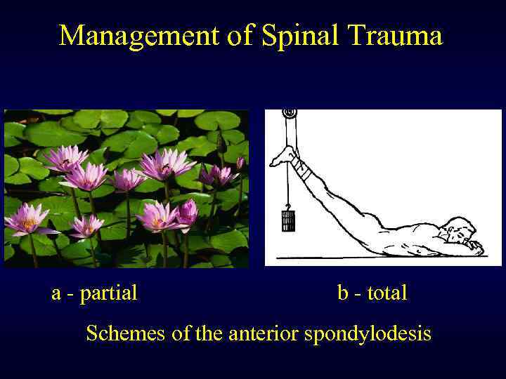 Management of Spinal Trauma a - partial b - total Schemes of the anterior