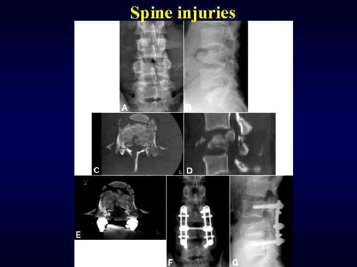 Spine injuries 