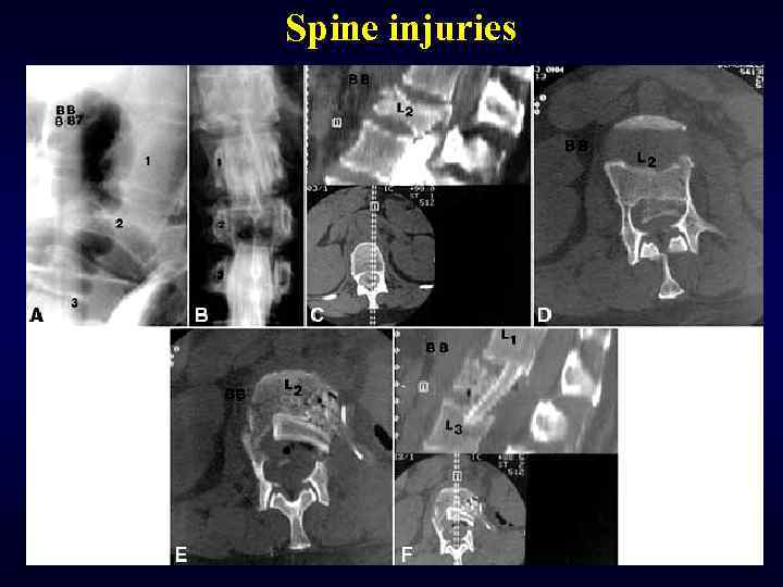 Spine injuries 
