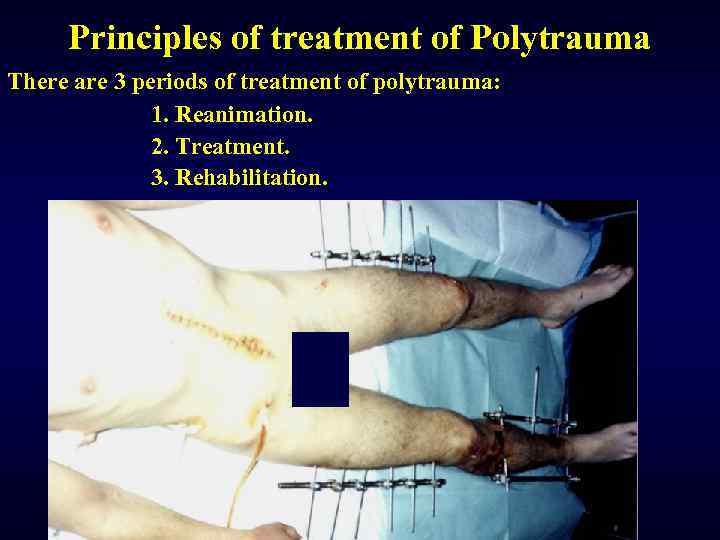 Principles of treatment of Polytrauma There are 3 periods of treatment of polytrauma: 1.