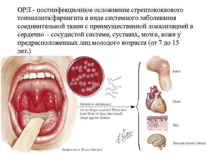 ОРЛ - постинфекционное осложнение стрептококкового тонзиллита/фарингита в виде системного заболевания соединительной ткани с преимущественной