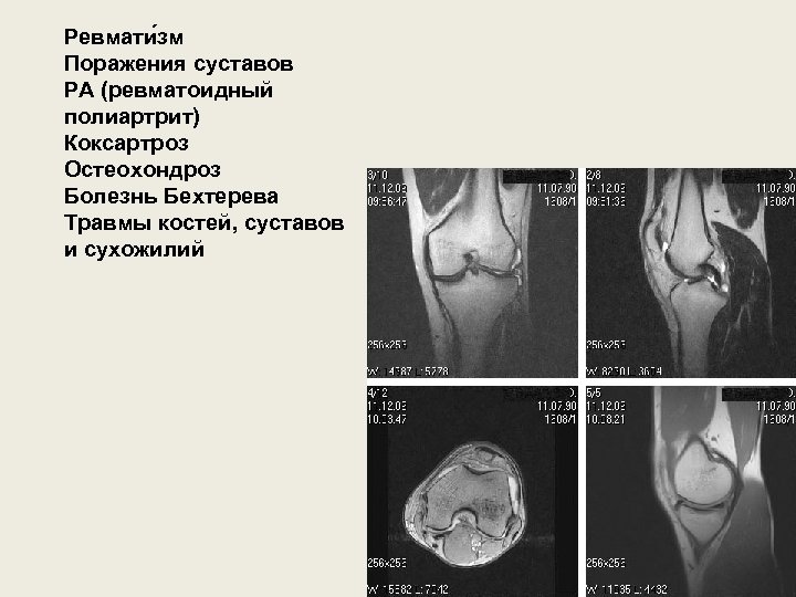 Ревмати зм Поражения суставов РА (ревматоидный полиартрит) Коксартроз Остеохондроз Болезнь Бехтерева Травмы костей, суставов