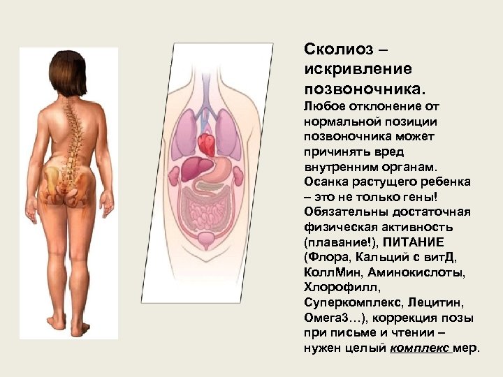 Сколиоз – искривление позвоночника. Любое отклонение от нормальной позиции позвоночника может причинять вред внутренним