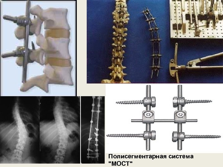 Полисегментарная система "МОСТ" 