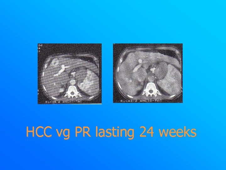 HCC vg PR lasting 24 weeks 