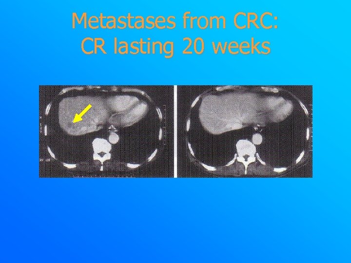 Metastases from CRC: CR lasting 20 weeks 