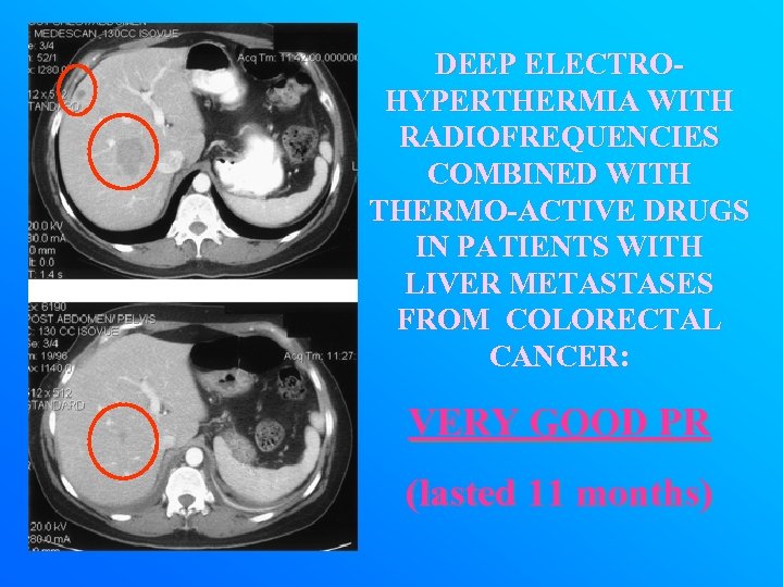 DEEP ELECTROHYPERTHERMIA WITH RADIOFREQUENCIES COMBINED WITH THERMO-ACTIVE DRUGS IN PATIENTS WITH LIVER METASTASES FROM
