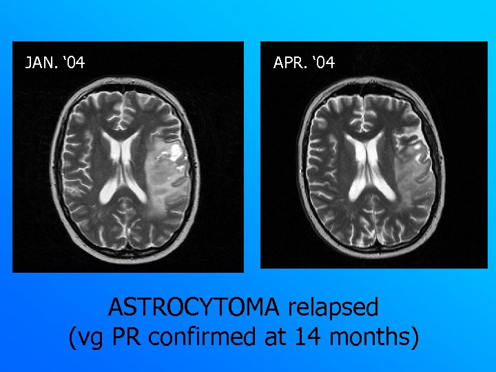 JAN. ‘ 04 APR. ‘ 04 ASTROCYTOMA relapsed (vg PR confirmed at 14 months)
