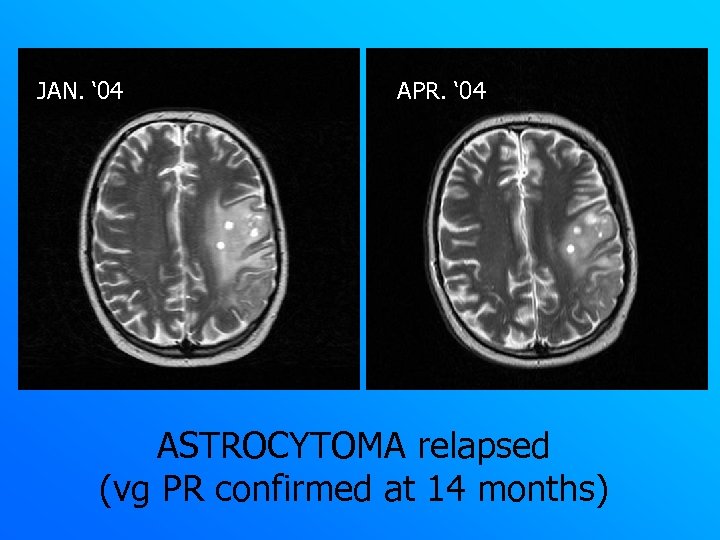 JAN. ‘ 04 APR. ‘ 04 ASTROCYTOMA relapsed (vg PR confirmed at 14 months)