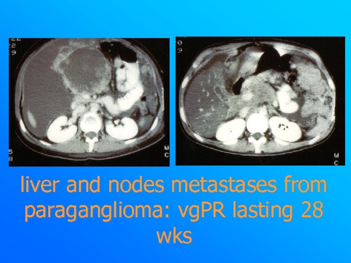 liver and nodes metastases from paraganglioma: vg. PR lasting 28 wks 